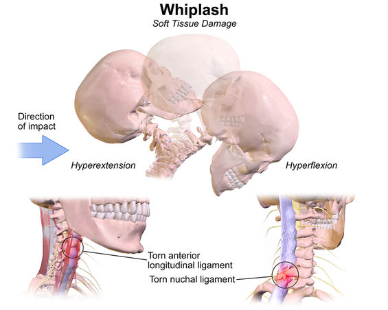 The Anatomy of a Whiplash Injury - Donald Physiotherapy